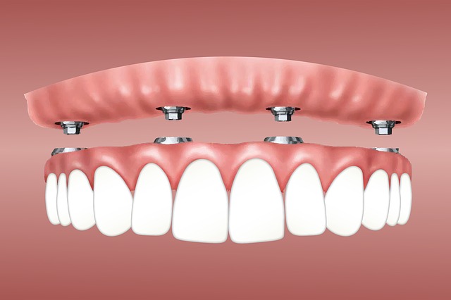 Tout ce que vous devrez savoir sur l’implantologie dentaire